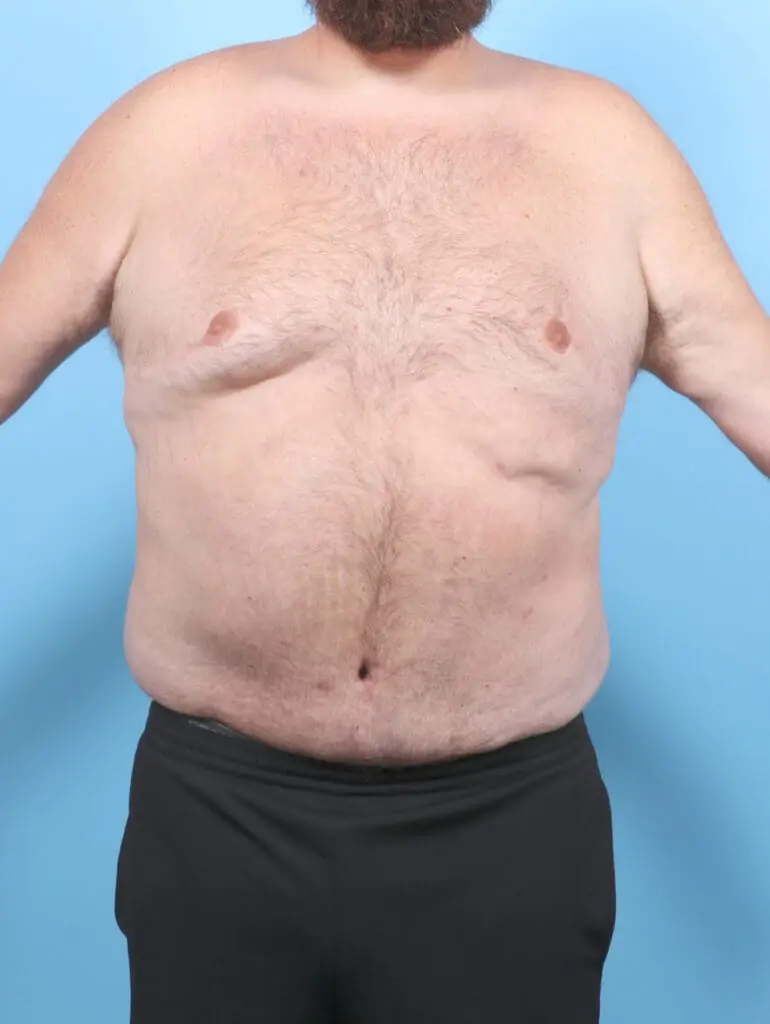 Male Tummy Tuck - Case 54893 - After