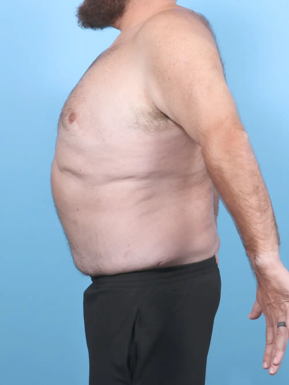 Male Tummy Tuck Patient Photo - Case 54893 - after view-2