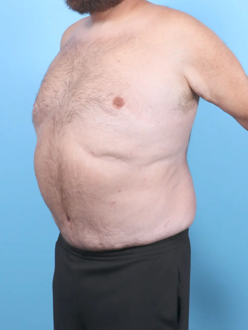 Male Tummy Tuck Patient Photo - Case 54893 - after view-1