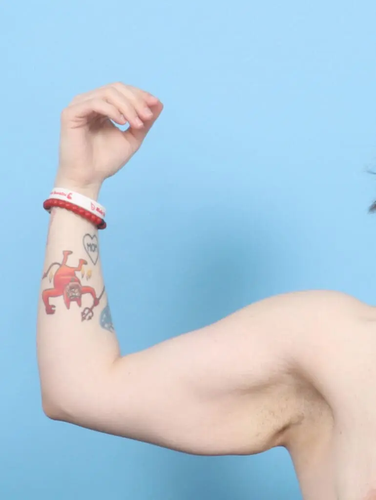 Arm Lift - Case 54933 - Before