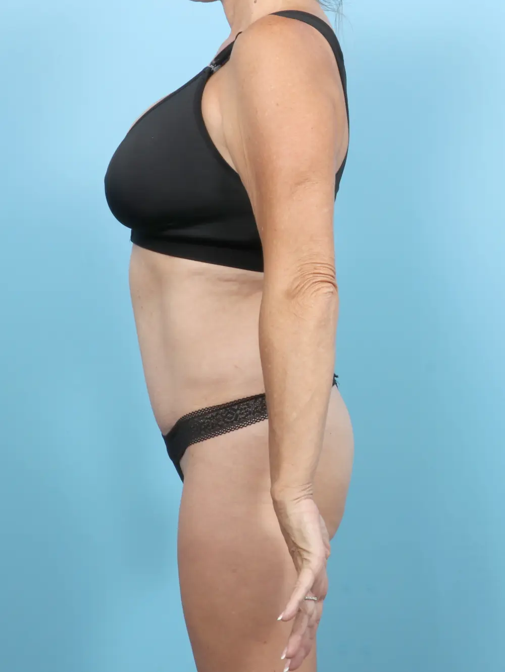 Tummy Tuck Patient Photo - Case 54939 - after view-2