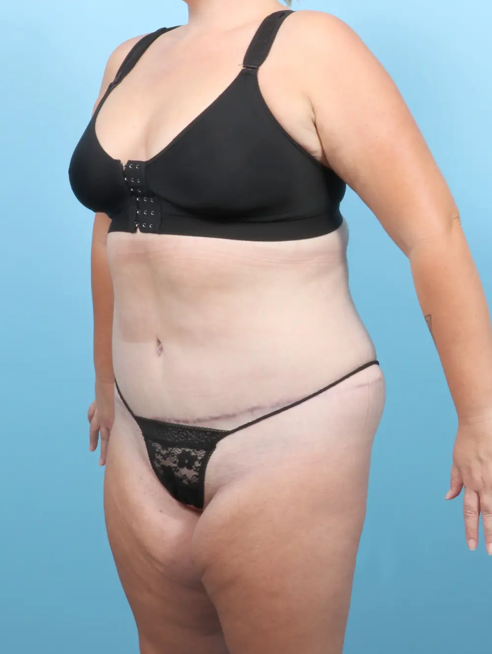 Tummy Tuck Patient Photo - Case 54993 - after view-1