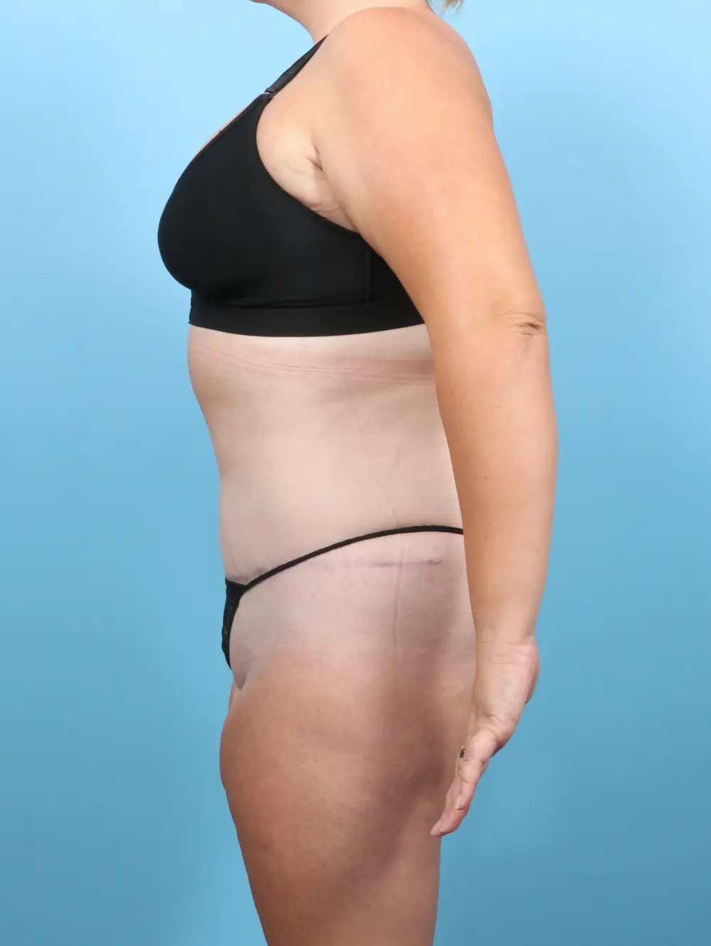 Tummy Tuck Patient Photo - Case 54993 - after view-2