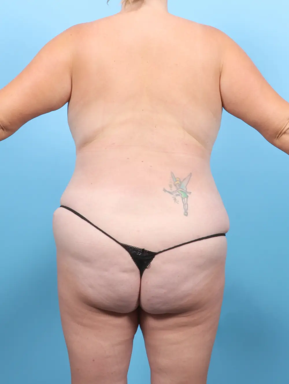 Tummy Tuck Patient Photo - Case 54993 - after view-3