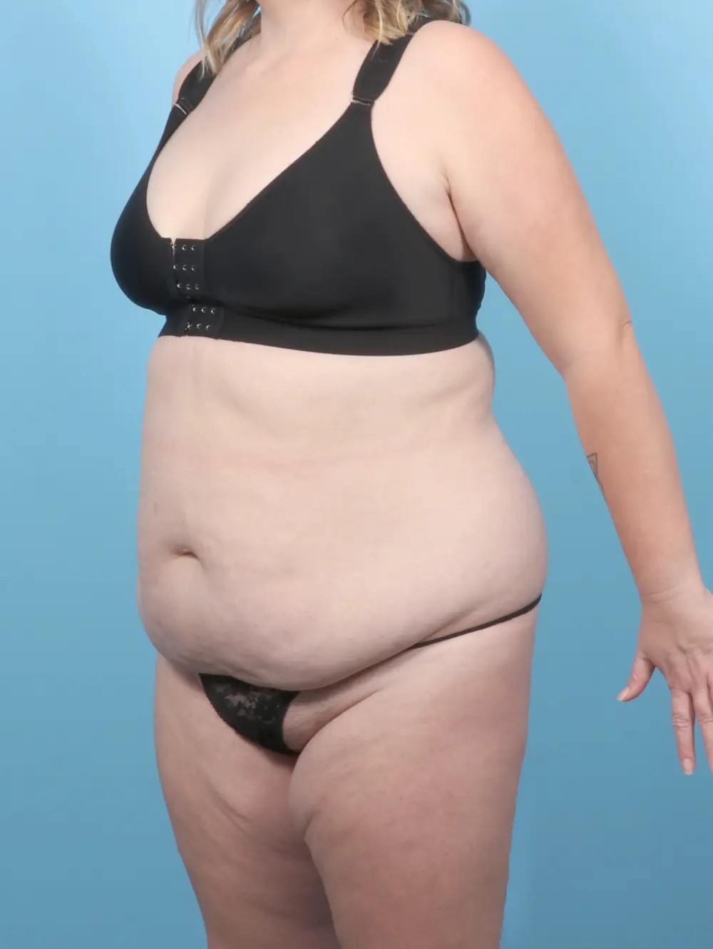 Tummy Tuck Patient Photo - Case 54993 - before view-1