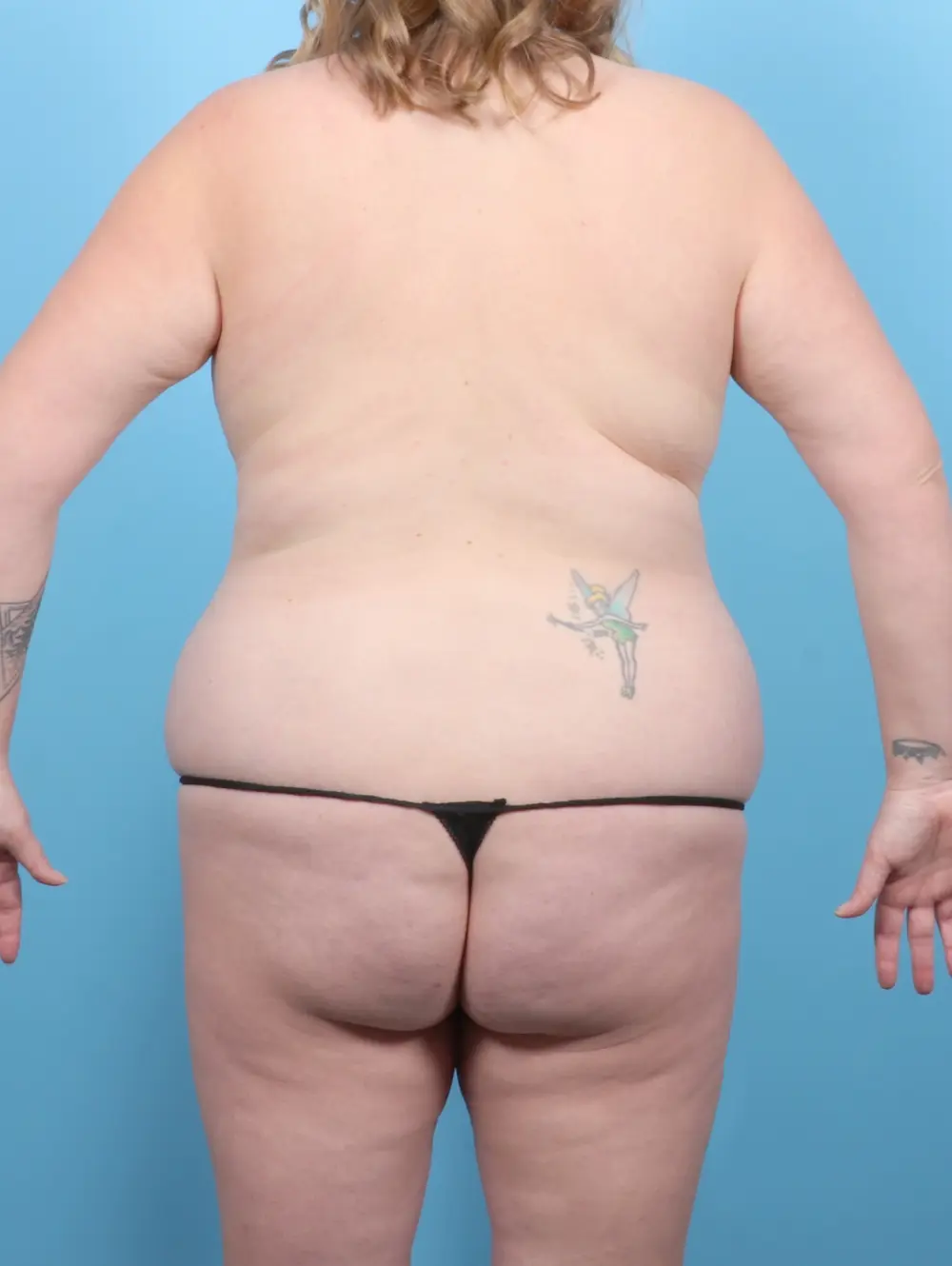 Tummy Tuck Patient Photo - Case 54993 - before view-3