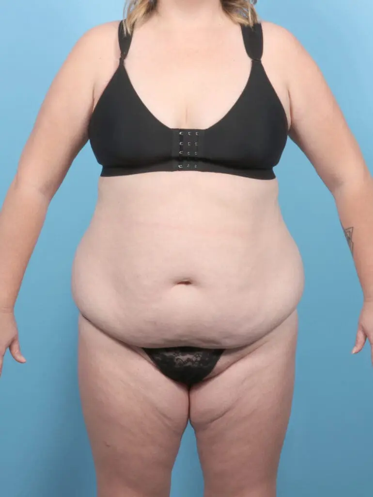 Tummy Tuck - Case 54993 - Before