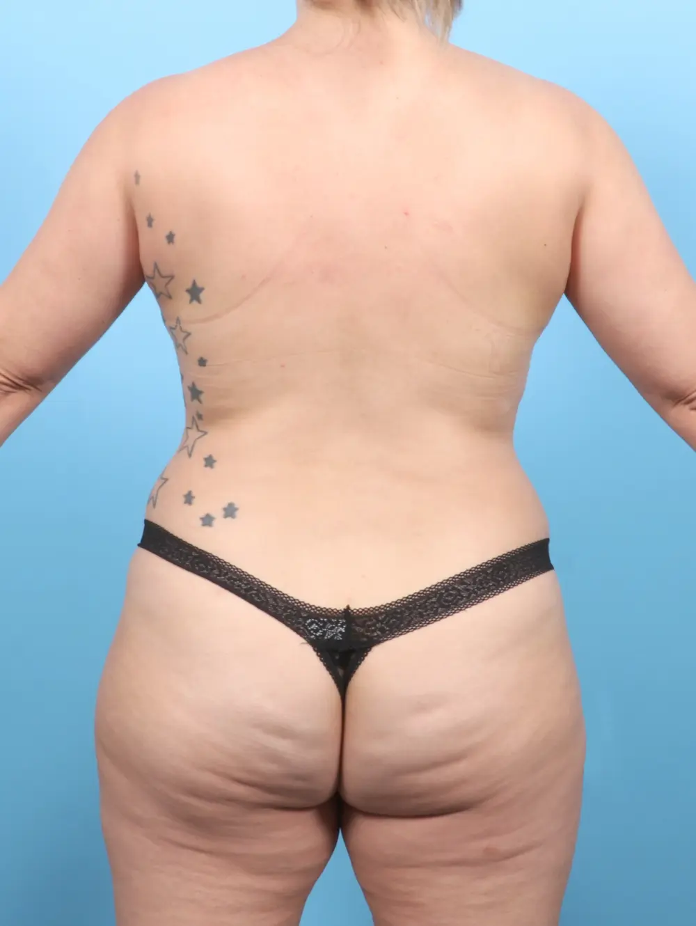 Breast Lift/Reduction w/o Implants Patient Photo - Case 55003 - after view-3