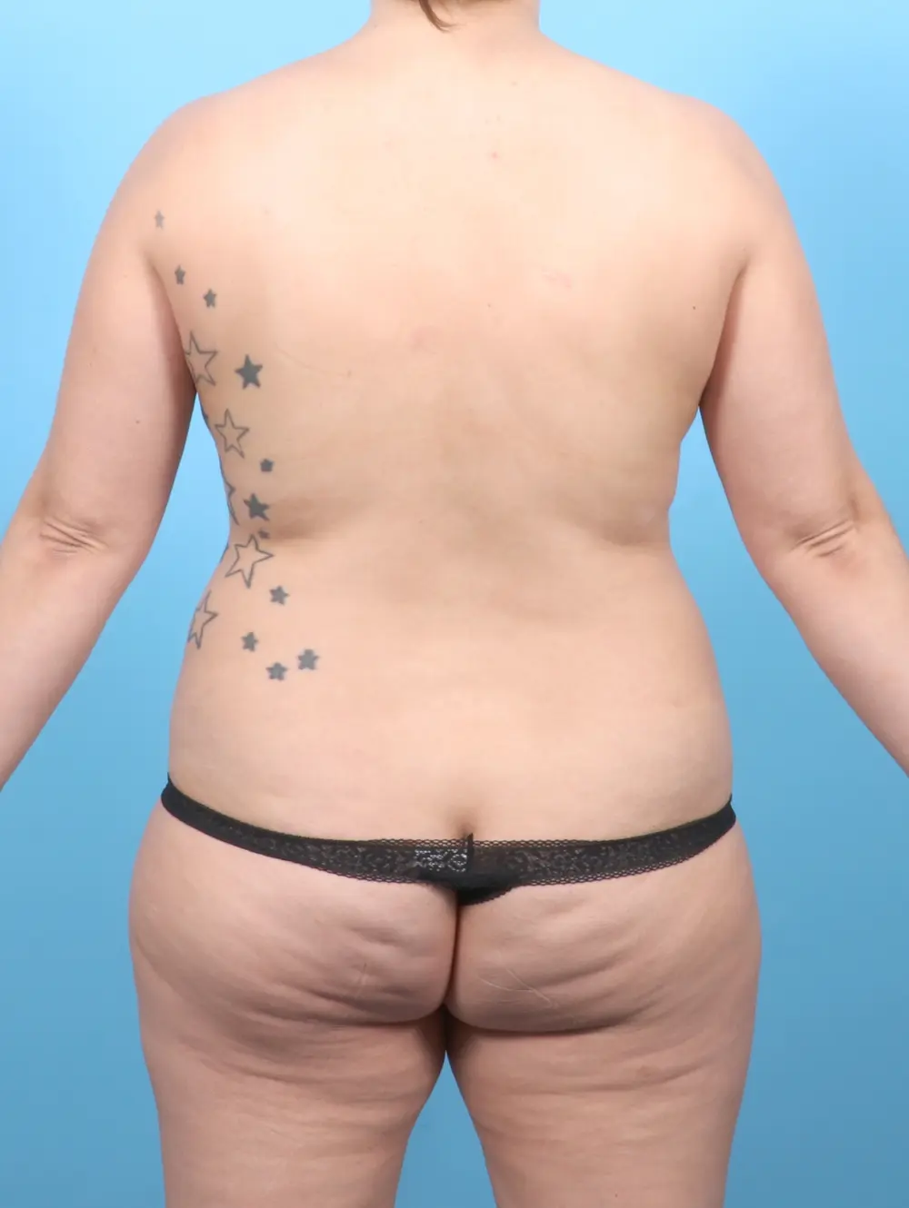 Breast Lift/Reduction w/o Implants Patient Photo - Case 55003 - before view-3