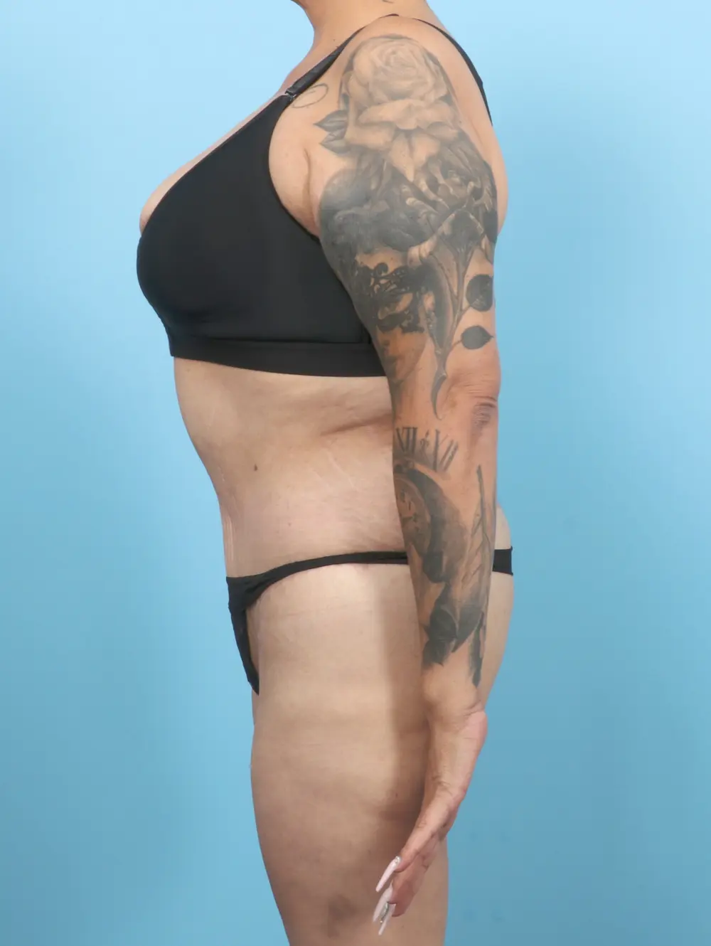 After Weight Loss Patient Photo - Case 55023 - after view-2