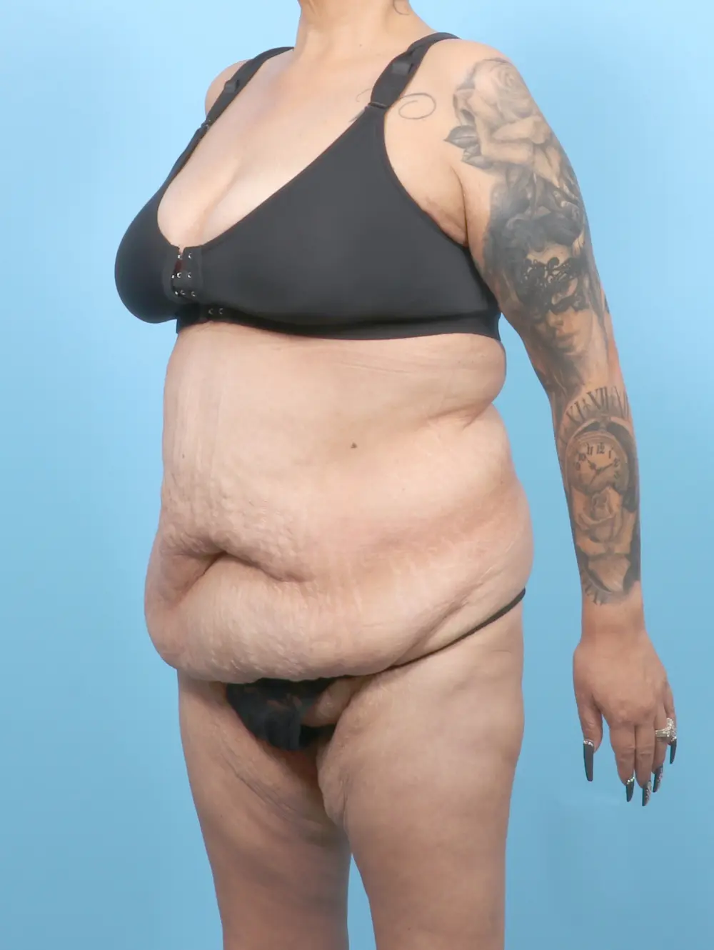 After Weight Loss Patient Photo - Case 55023 - before view-1