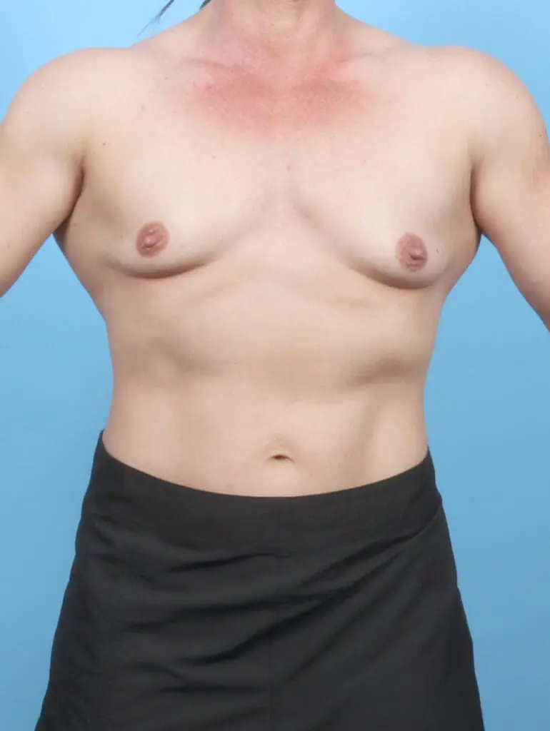 Breast Augmentation - Case 55049 - Before