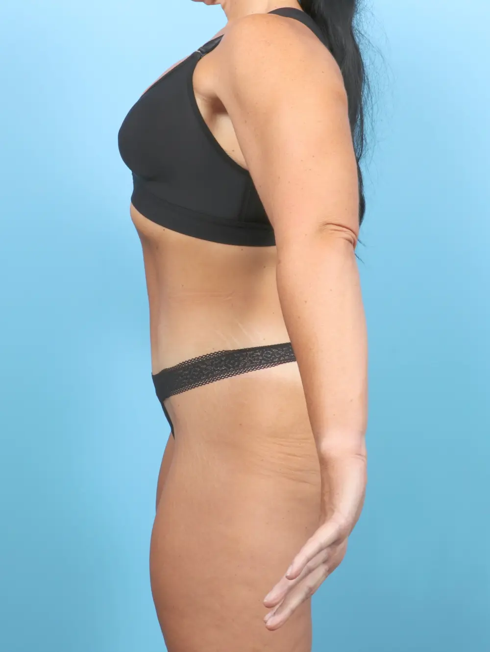 Tummy Tuck Patient Photo - Case 55057 - after view-2
