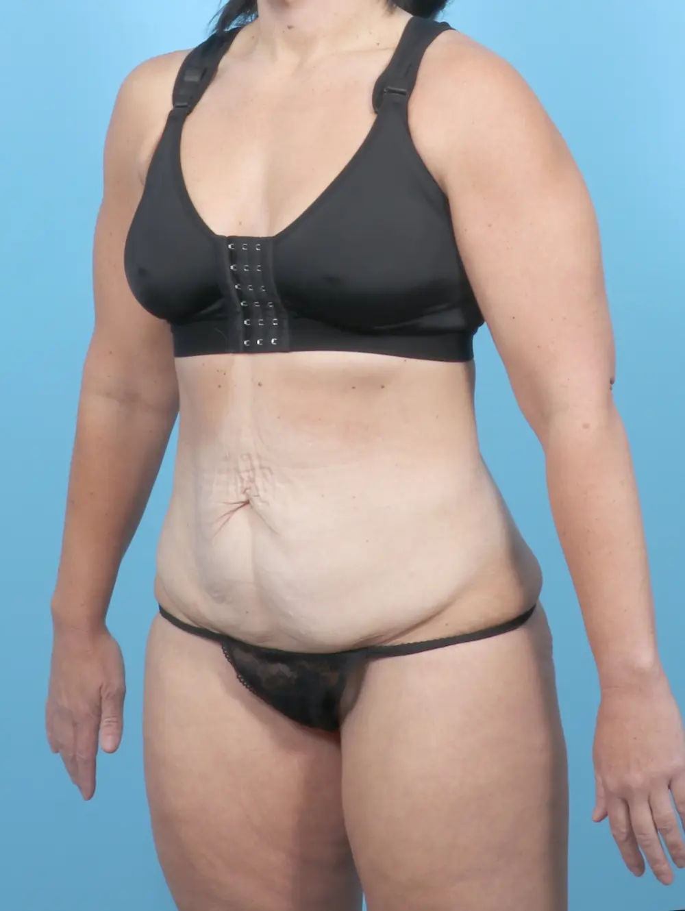 Tummy Tuck Patient Photo - Case 55057 - before view-1