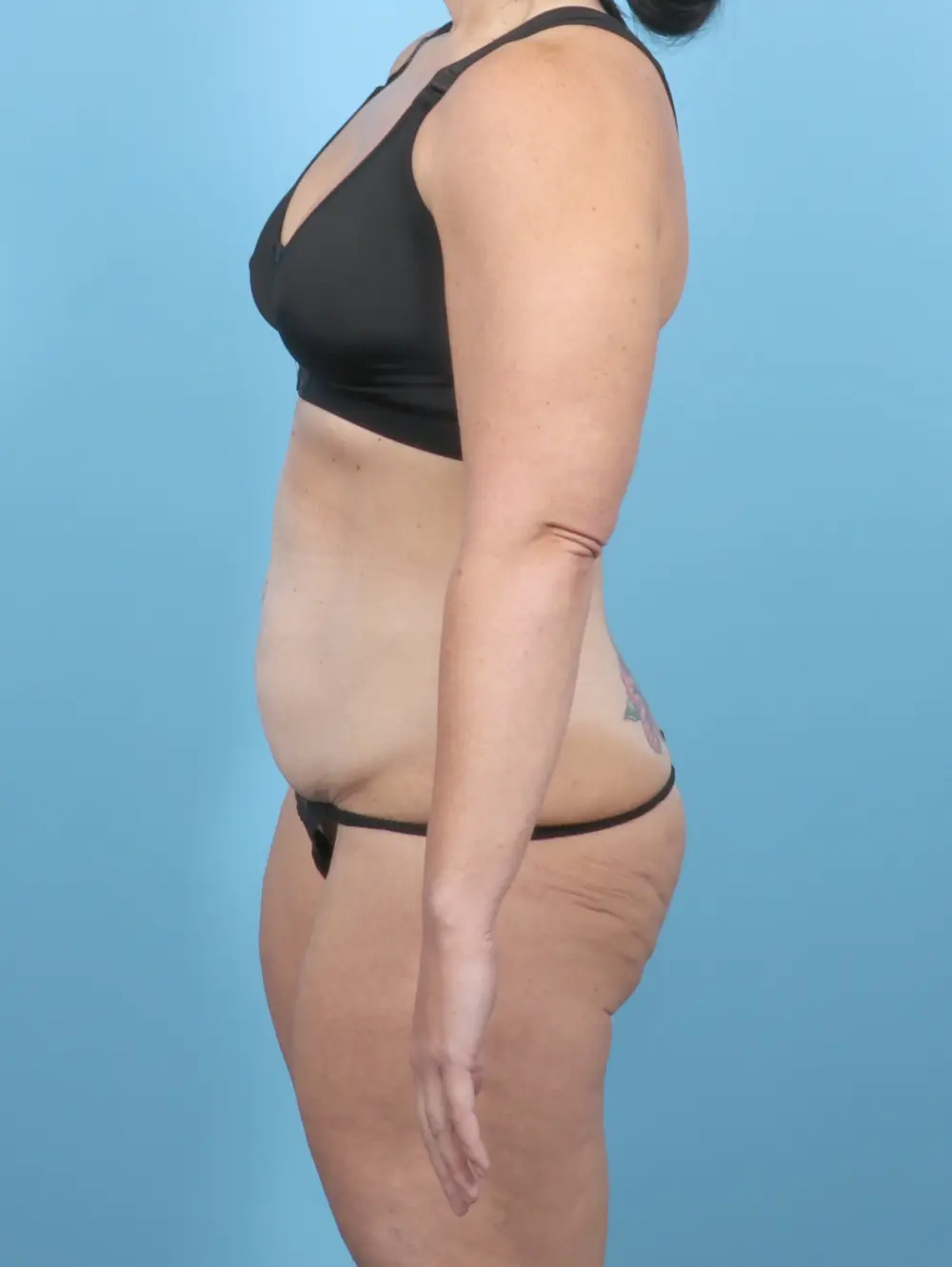 Tummy Tuck Patient Photo - Case 55057 - before view-2