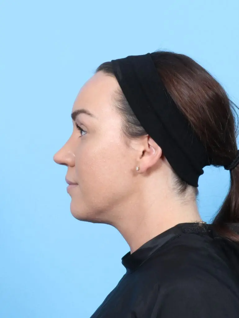 Rhinoplasty - Case 55073 - After