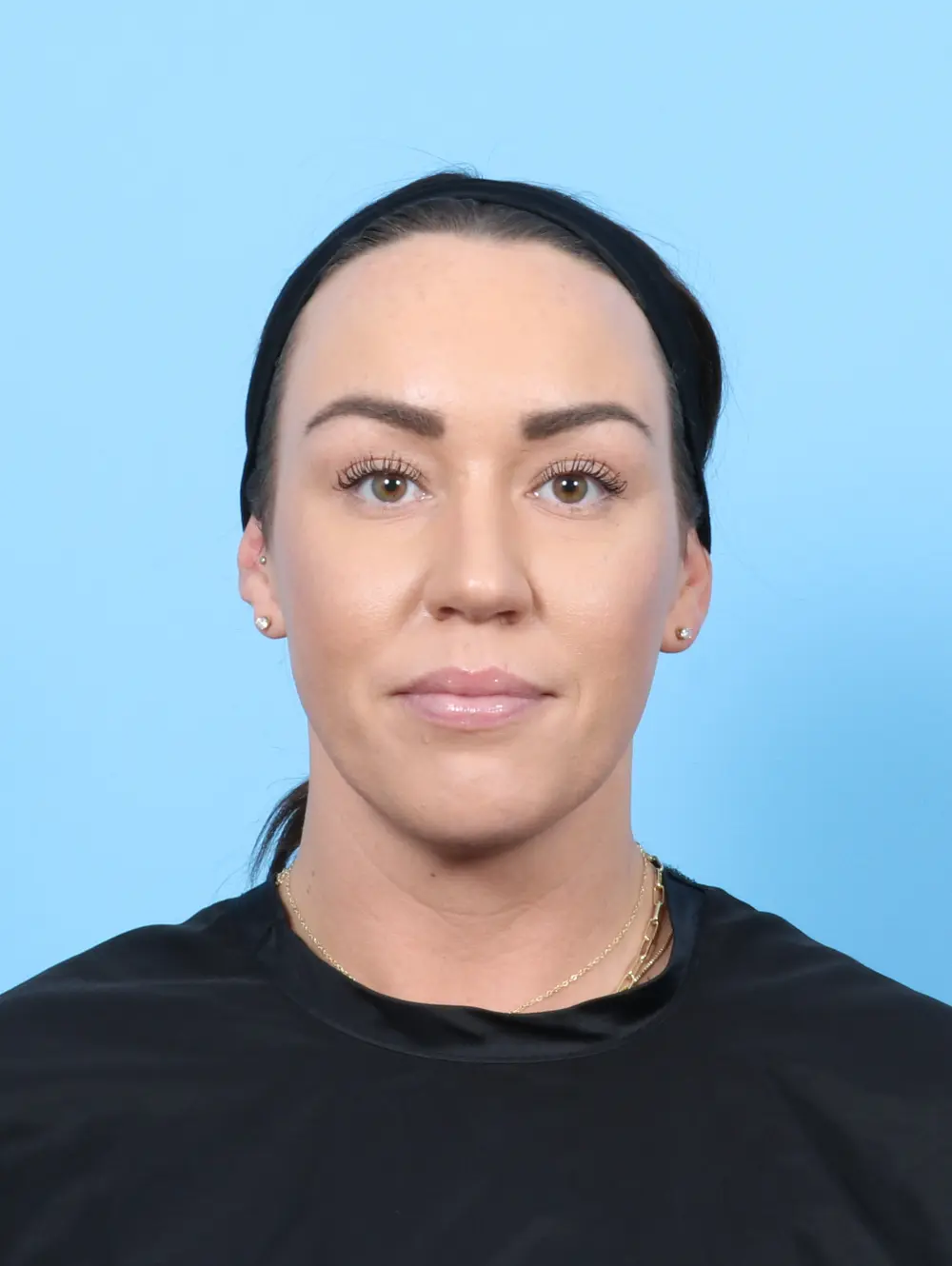 Rhinoplasty Patient Photo - Case 55073 - after view-2