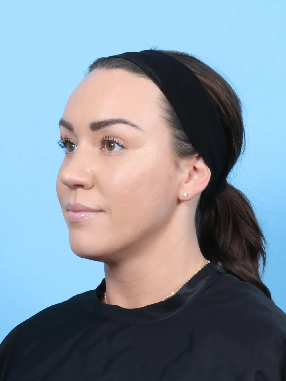 Rhinoplasty Patient Photo - Case 55073 - after view-1