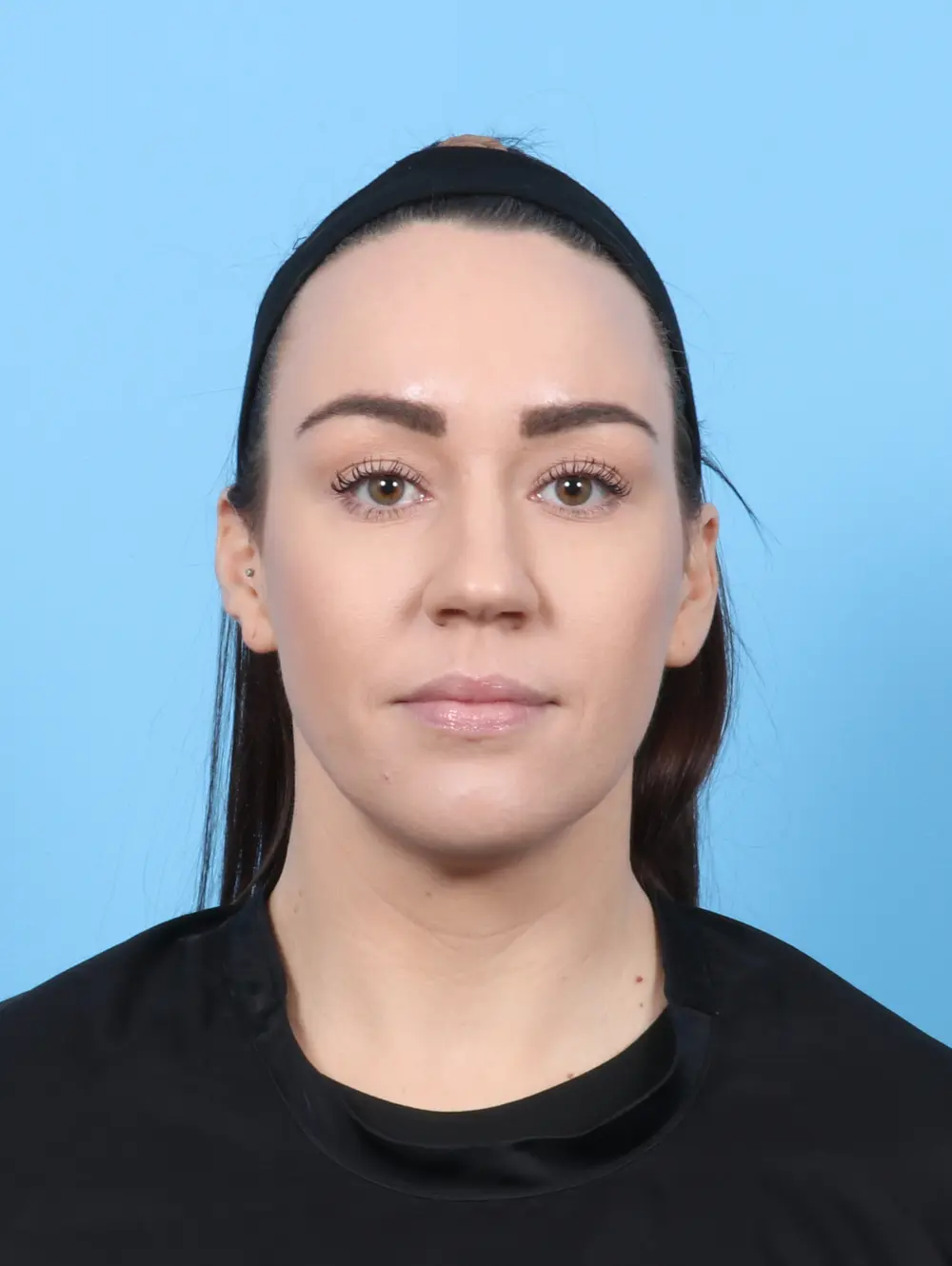 Rhinoplasty Patient Photo - Case 55073 - before view-2
