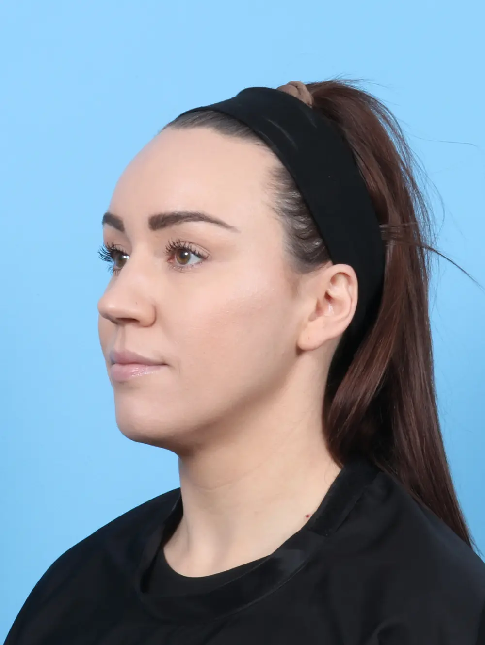 Rhinoplasty Patient Photo - Case 55073 - before view-1