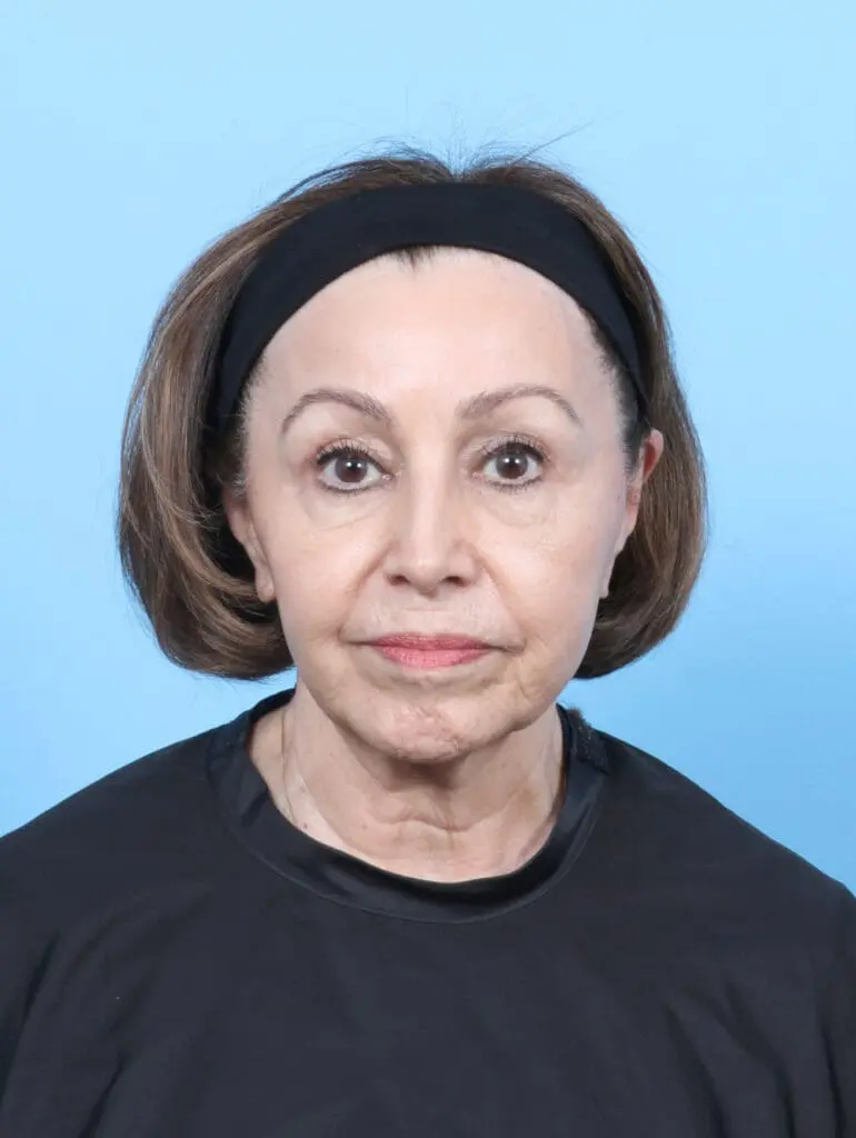 Eyelid Surgery - Case 55081 - After