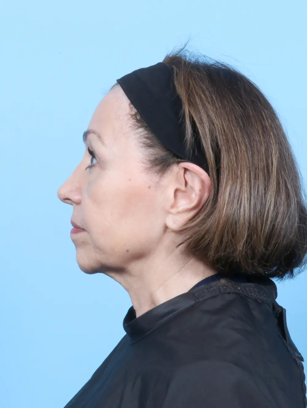 Eyelid Surgery Patient Photo - Case 55081 - after view-2