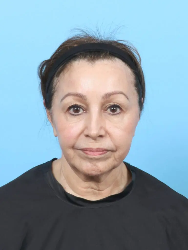 Eyelid Surgery - Case 55081 - Before