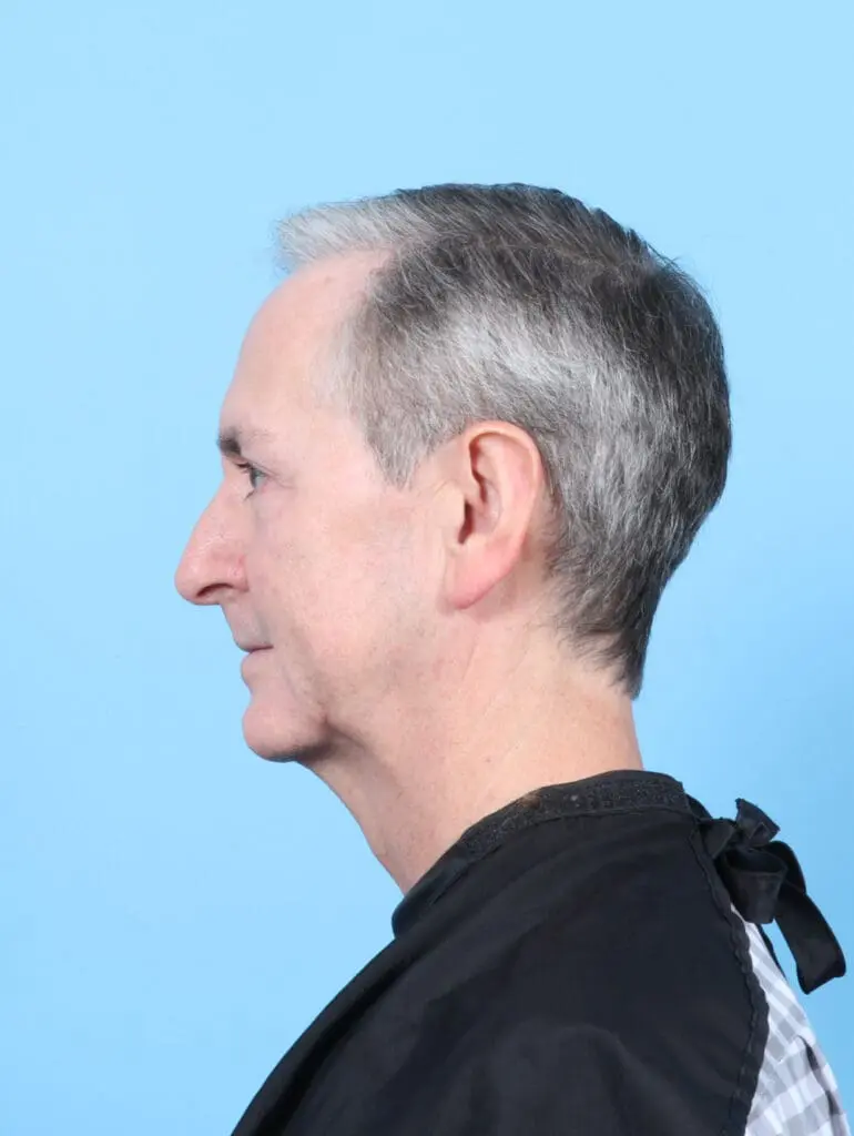 Chin Implant - Case 55097 - After