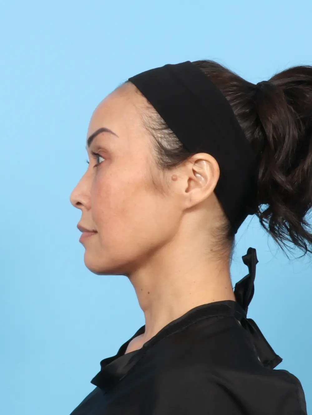 Eyelid Surgery Patient Photo - Case 55099 - before view-2