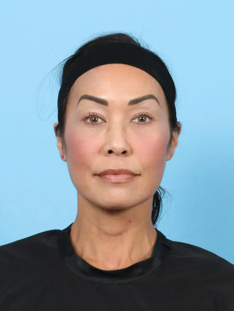 Eyelid Surgery - Case 55099 - After