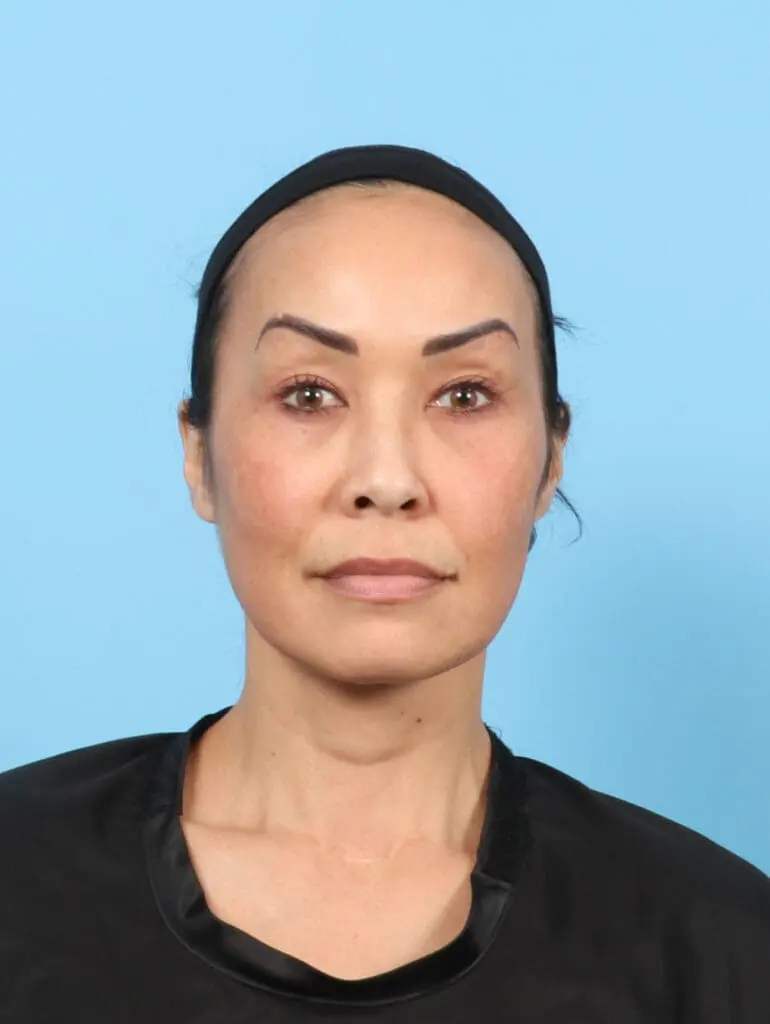 Eyelid Surgery - Case 55099 - Before