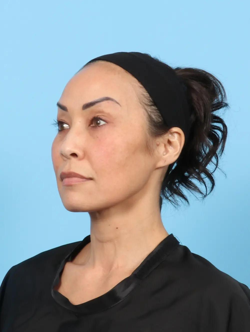 Eyelid Surgery Patient Photo - Case 55099 - before view-1