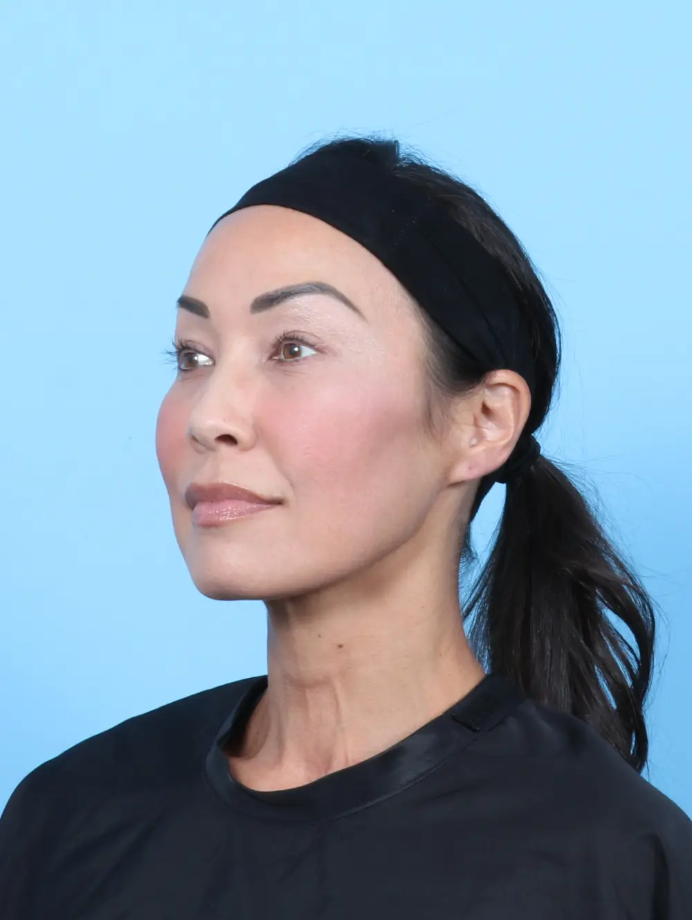 Eyelid Surgery Patient Photo - Case 55099 - after view-1