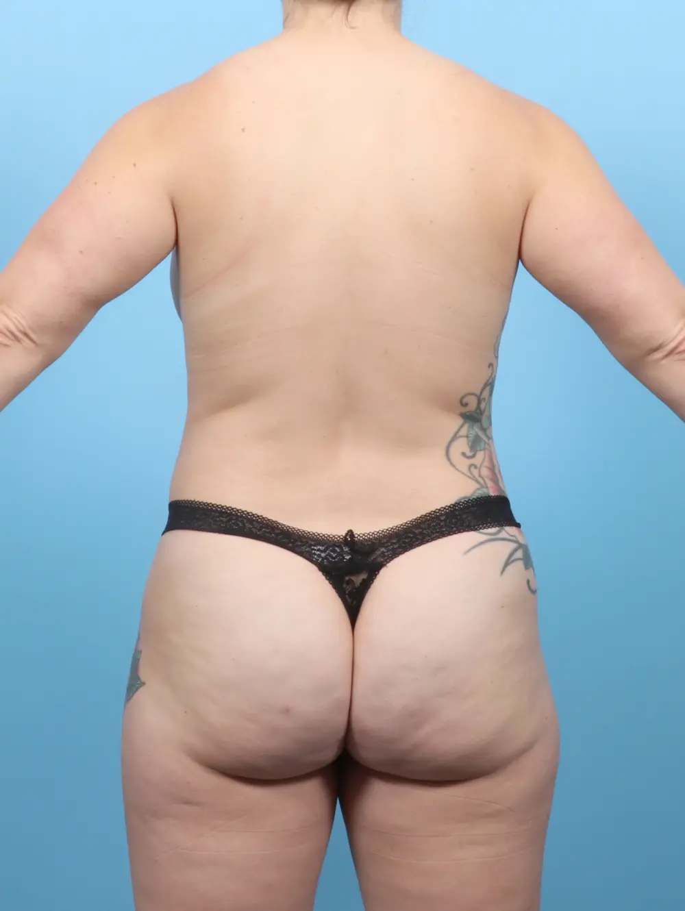 Tummy Tuck Patient Photo - Case 55107 - before view-3