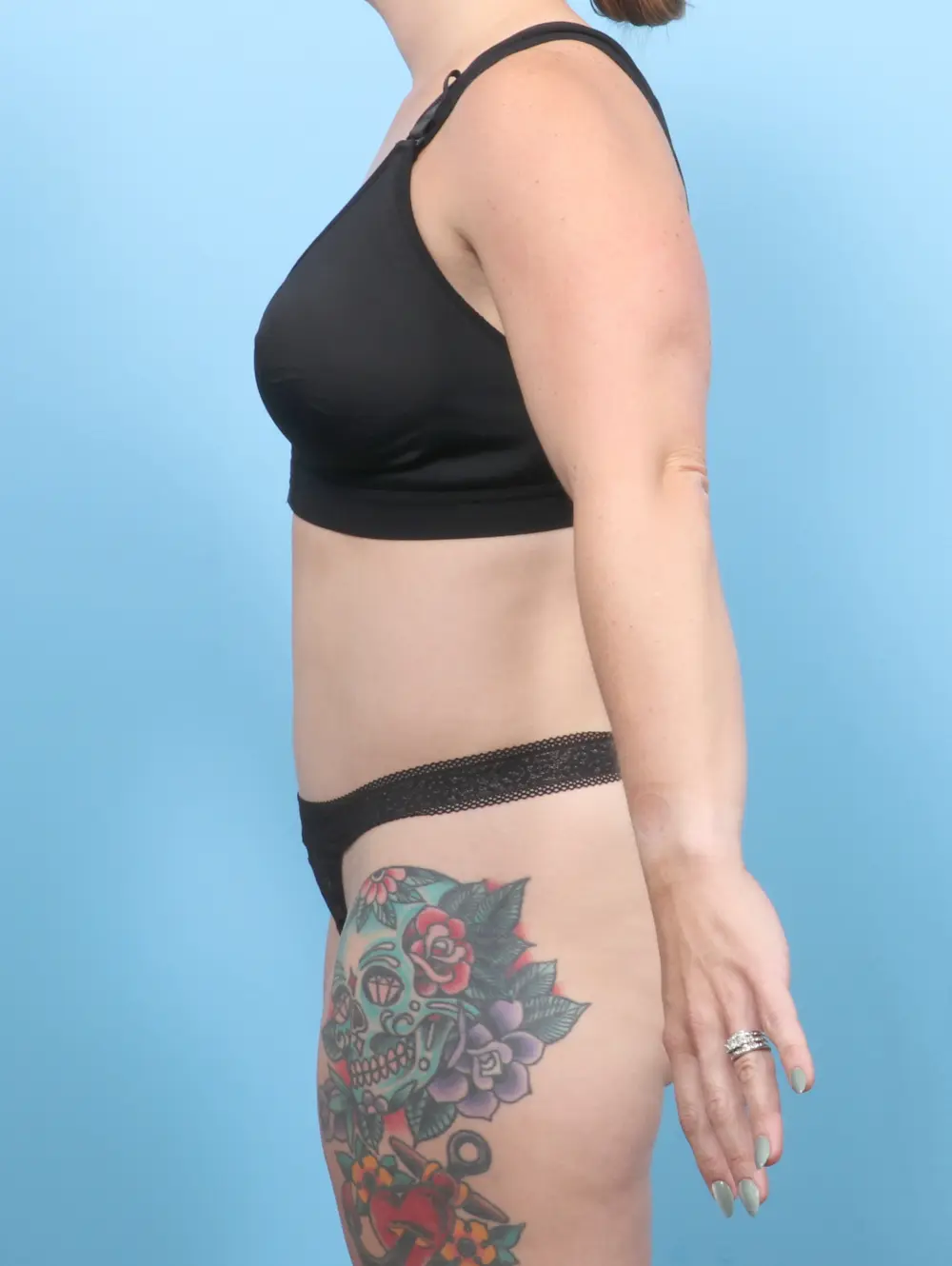 Tummy Tuck Patient Photo - Case 55107 - after view-2
