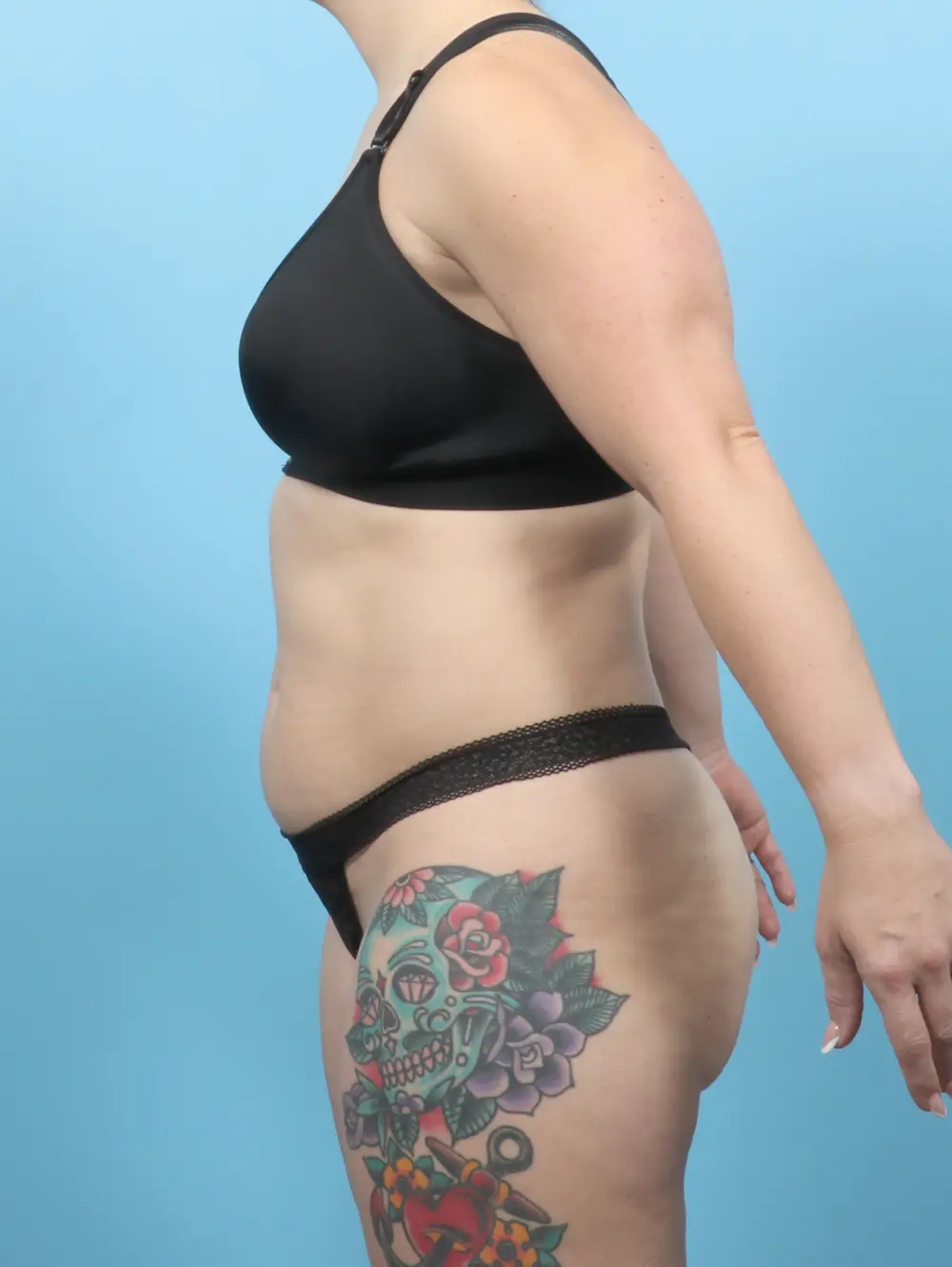 Tummy Tuck Patient Photo - Case 55107 - before view-2