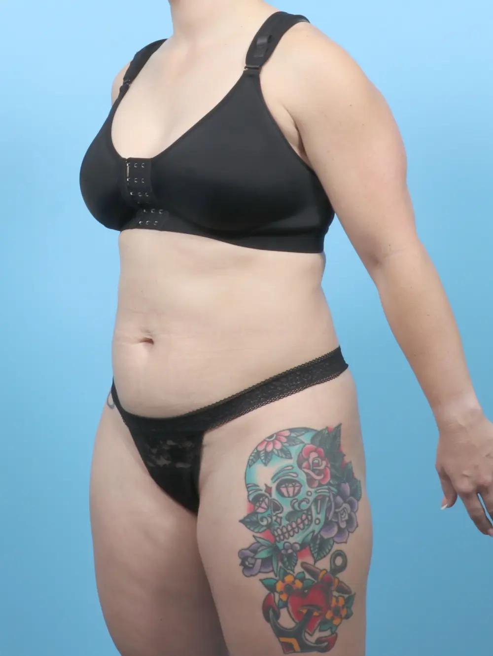 Tummy Tuck Patient Photo - Case 55107 - before view-1