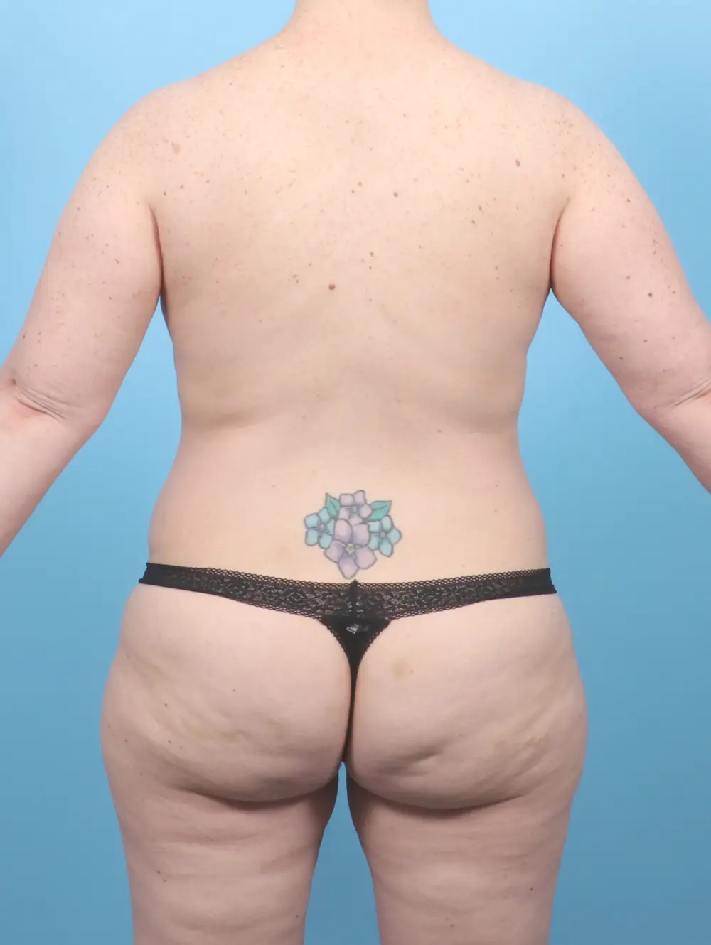 Breast Lift/Reduction with Implants Patient Photo - Case 55117 - before view-3