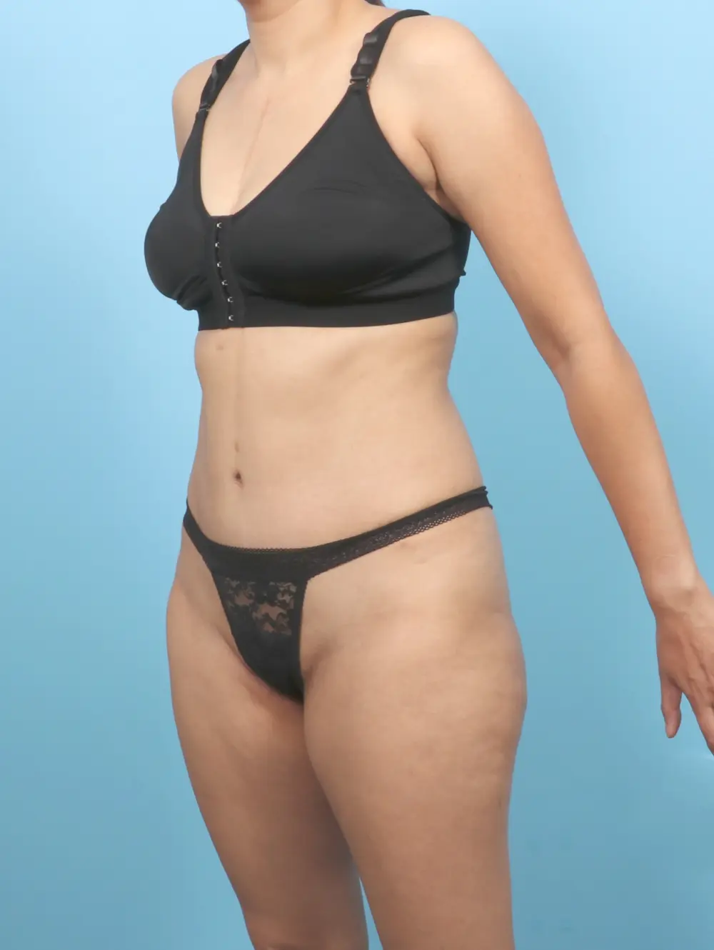 Tummy Tuck Patient Photo - Case 55135 - after view-1