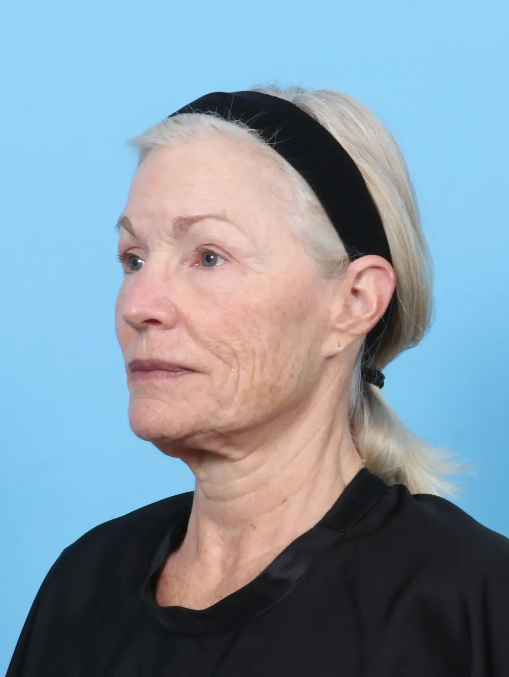 Facelift / Neck Lift Patient Photo - Case 55159 - before view-1