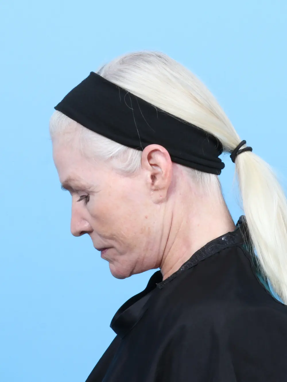 Facelift / Neck Lift Patient Photo - Case 55159 - after view-3