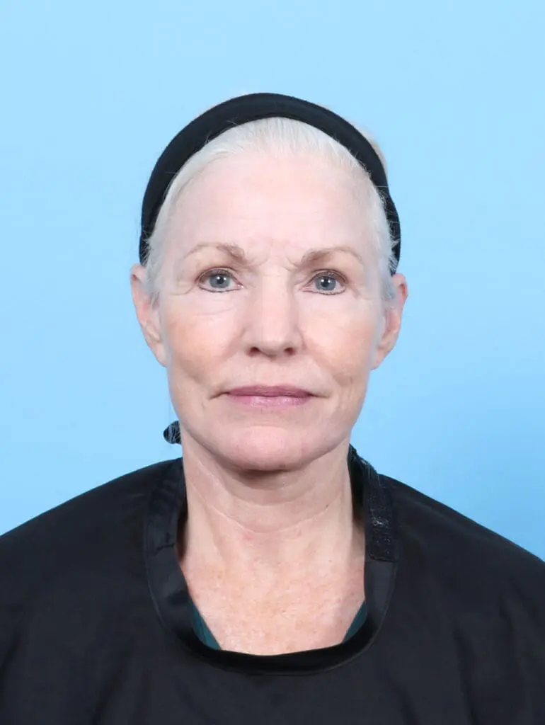 Facelift / Neck Lift - Case 55159 - After