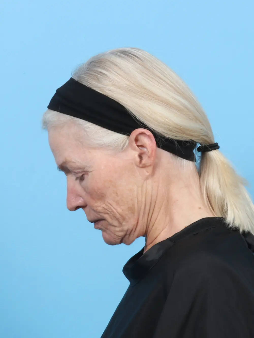 Facelift / Neck Lift Patient Photo - Case 55159 - before view-3