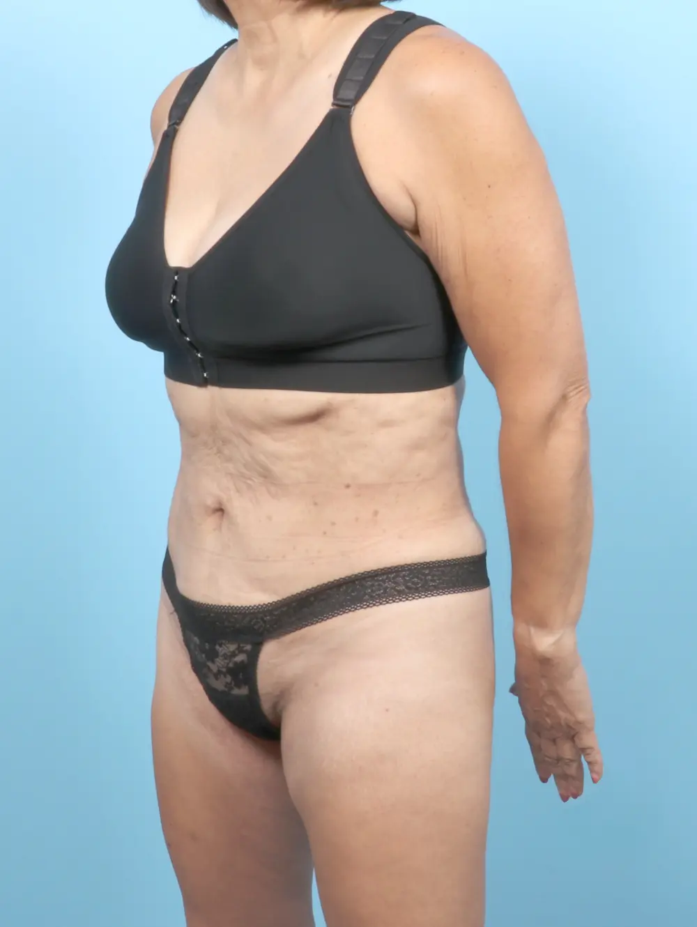 Liposuction Patient Photo - Case 55177 - after view-1