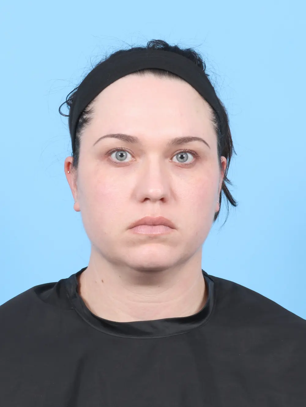 Liposuction Patient Photo - Case 55201 - before view-2