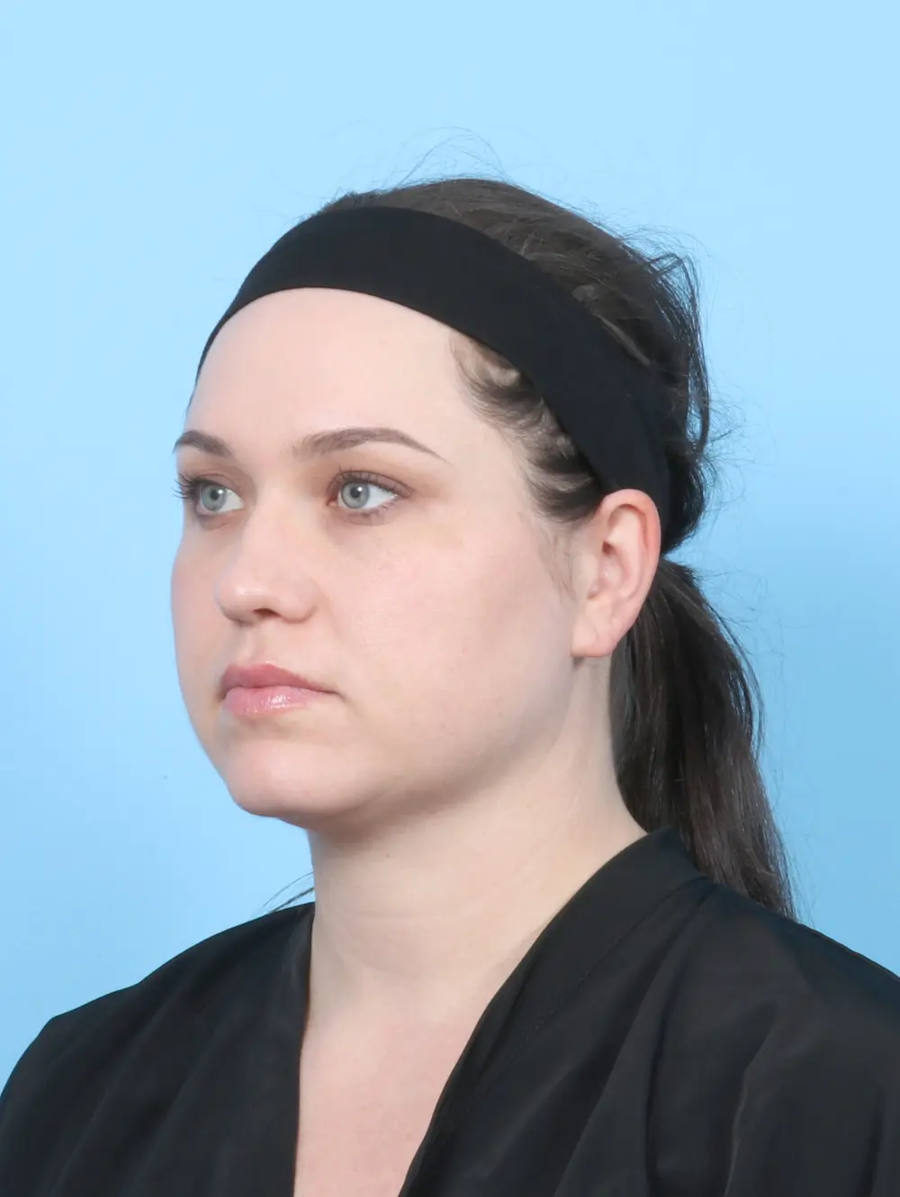 Liposuction Patient Photo - Case 55201 - after view-1