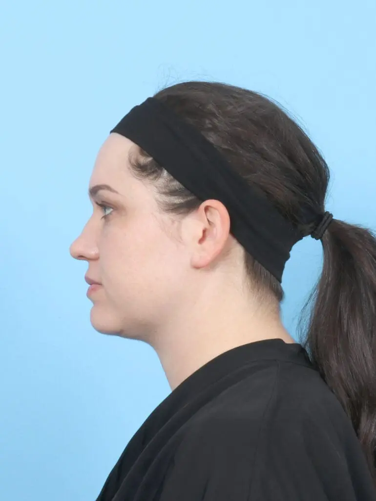 Liposuction - Case 55201 - After