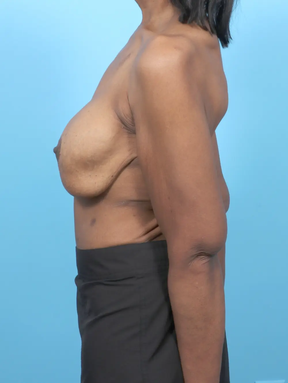 After Weight Loss Patient Photo - Case 55226 - before view-2