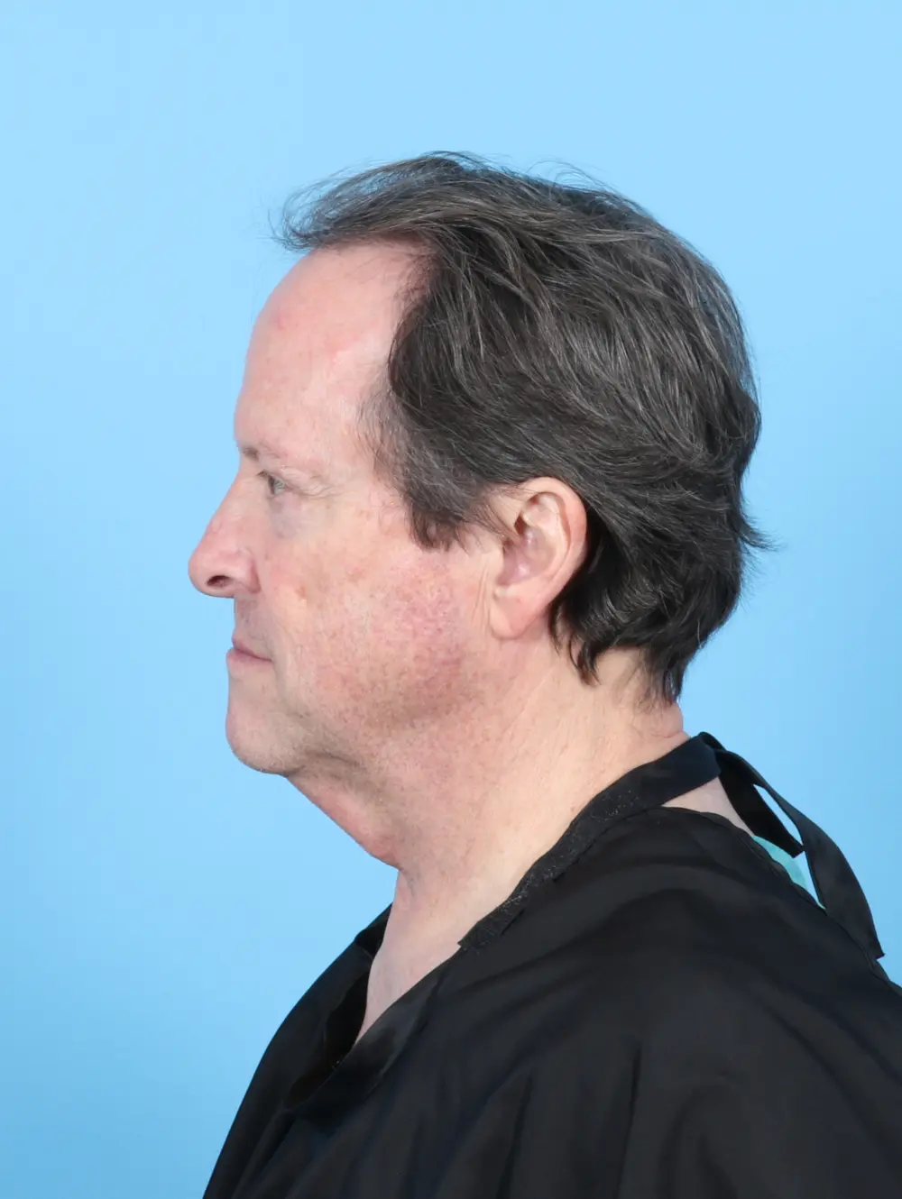 Facelift / Neck Lift Patient Photo - Case 55255 - before view-2