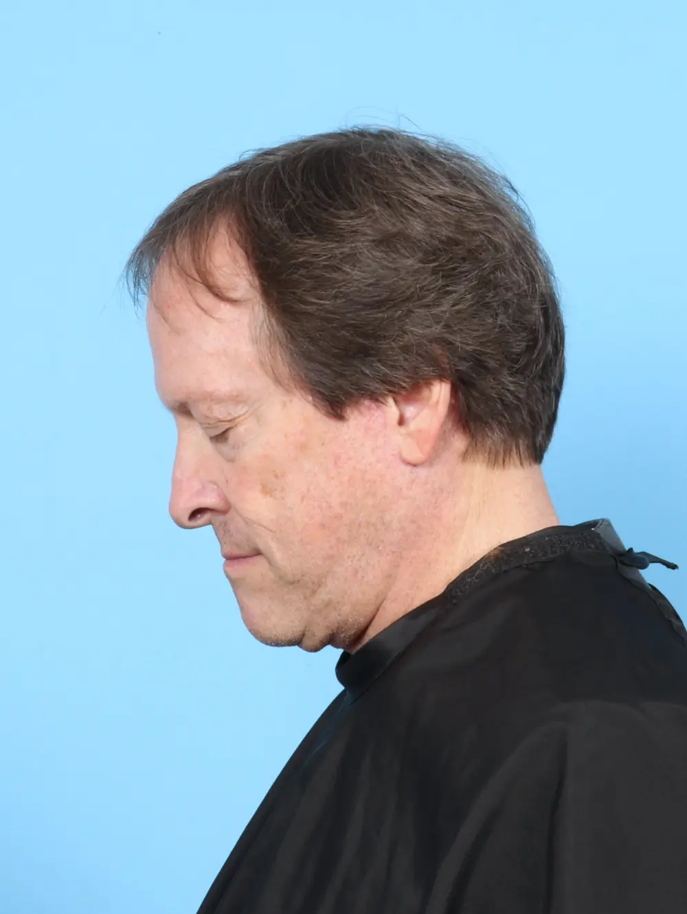 Facelift / Neck Lift Patient Photo - Case 55255 - after view-3